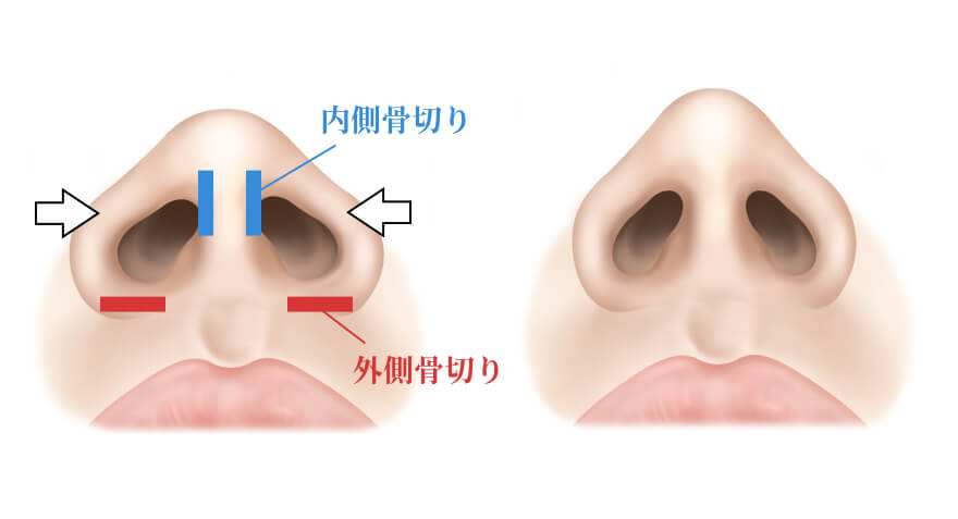 鼻骨骨切幅寄せ