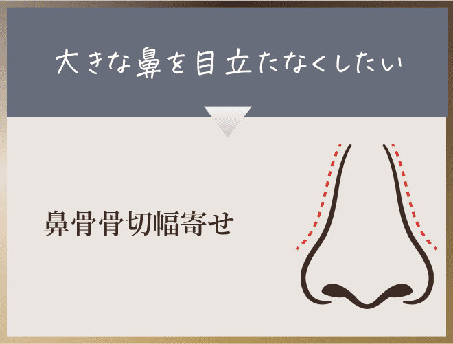 鼻骨骨切幅寄せ